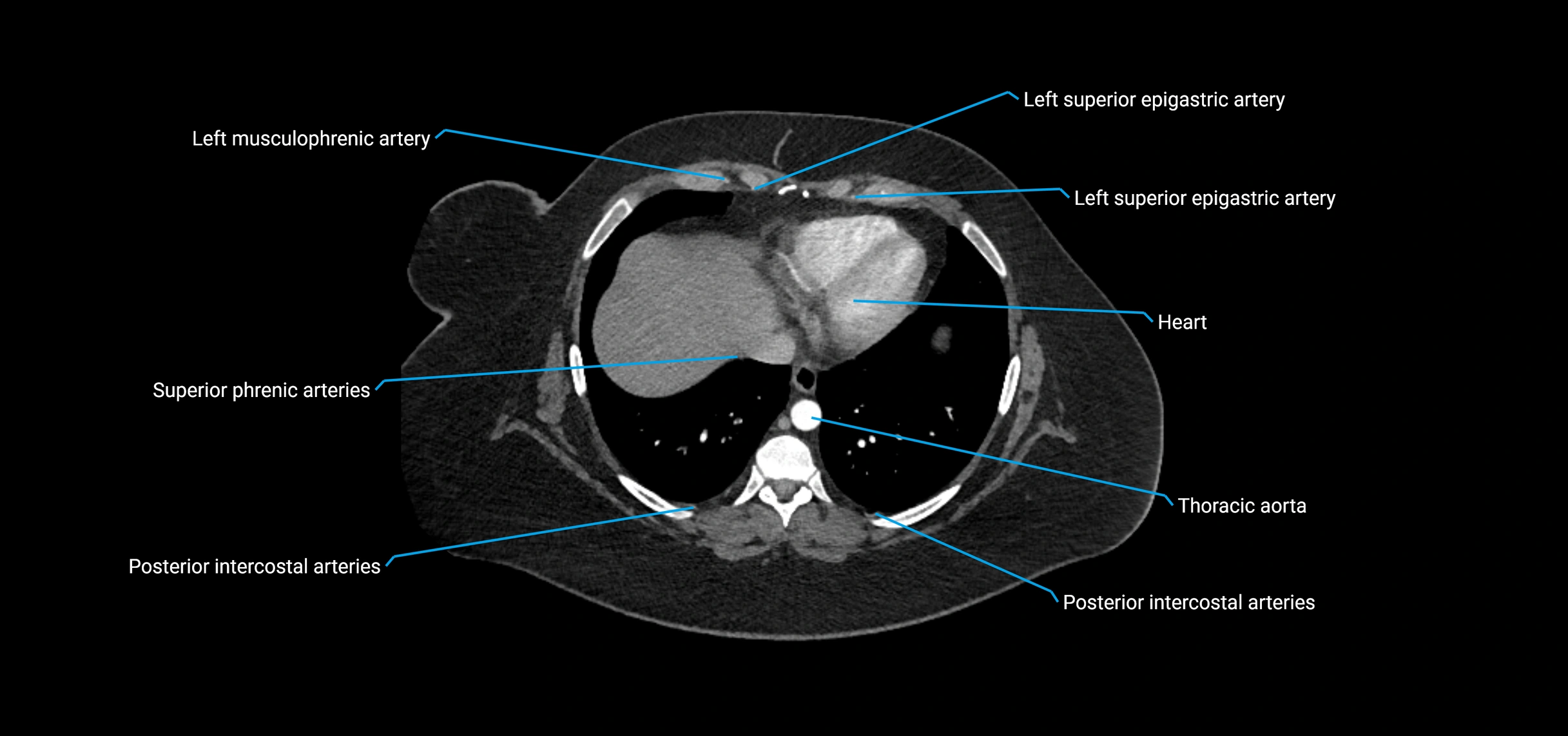 CTA abdomen axial cross sectional anatomy labelled image_11 (1).webp
